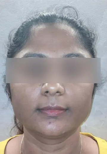 Signature Facial Before and after results at Dermatrix Clinic