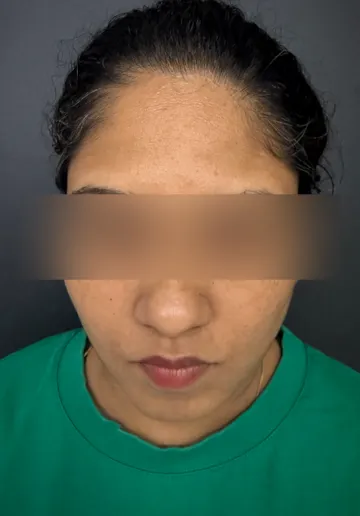 Freckle Removal Before and after results at Dermatrix Clinic