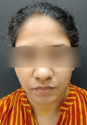 Freckle Removal Before and after results at Dermatrix Clinic