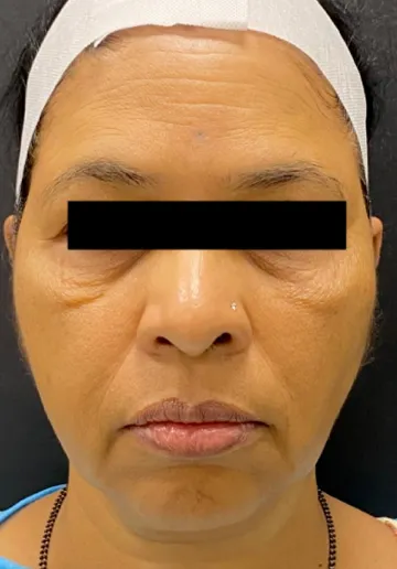 Dermal Fillers Before and after results at Dermatrix Clinic