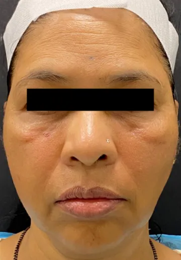 Dermal Fillers Before and after results at Dermatrix Clinic