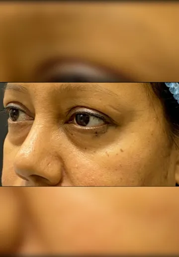 Dermal Fillers Before and after results at Dermatrix Clinic