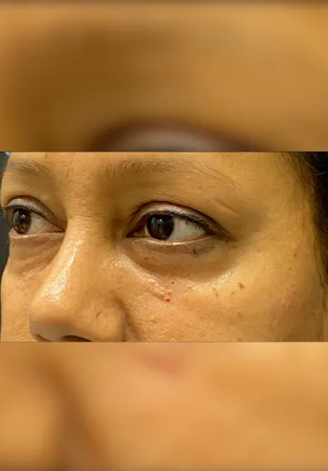 Dermal Fillers Before and after results at Dermatrix Clinic