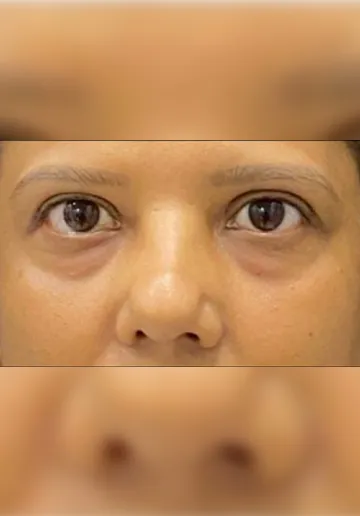 Dermal Fillers Before and after results at Dermatrix Clinic