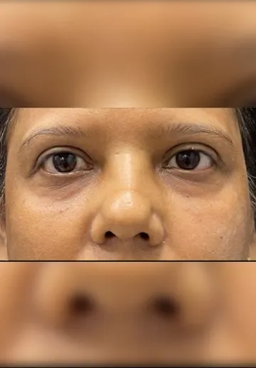 Dermal Fillers Before and after results at Dermatrix Clinic