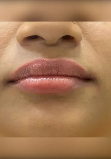 Dermal Fillers Before and after results at Dermatrix Clinic