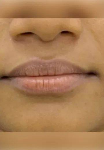 Dermal Fillers Before and after results at Dermatrix Clinic