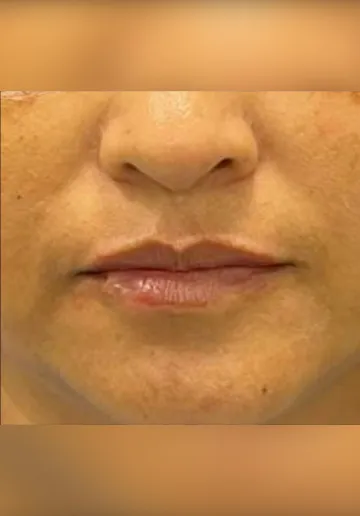 Dermal Fillers Before and after results at Dermatrix Clinic