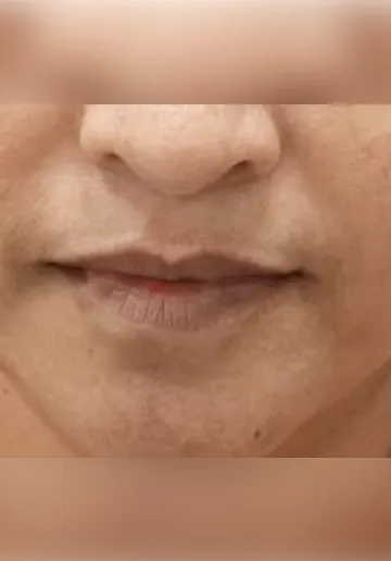 Dermal Fillers Before and after results at Dermatrix Clinic