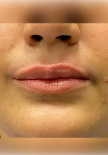 Dermal Fillers Before and after results at Dermatrix Clinic