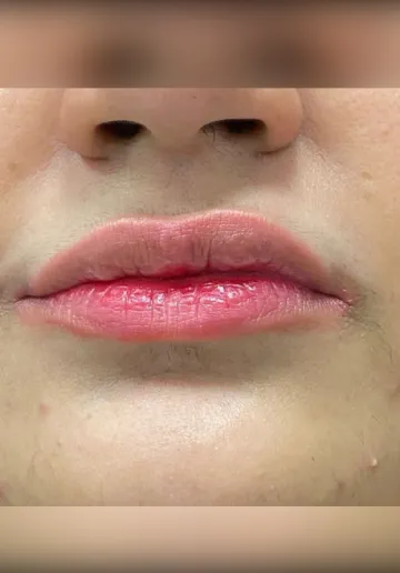 Dermal Fillers Before and after results at Dermatrix Clinic
