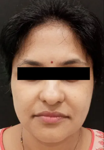 Dermal Fillers Before and after results at Dermatrix Clinic