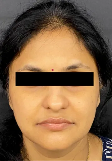Dermal Fillers Before and after results at Dermatrix Clinic