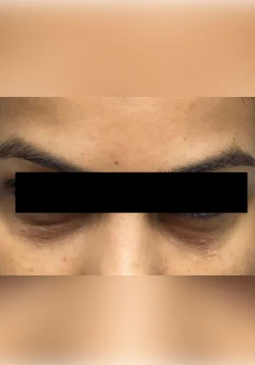 Dermal Fillers Before and after results at Dermatrix Clinic