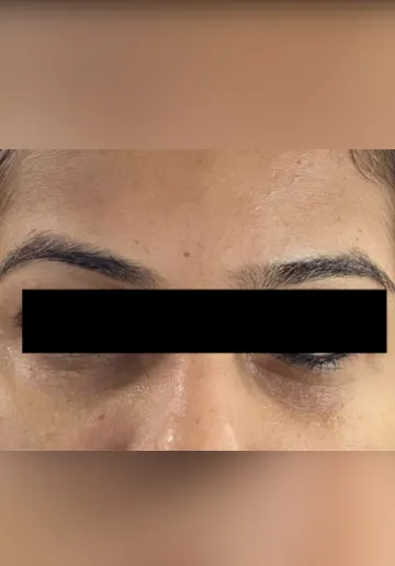 Dermal Fillers Before and after results at Dermatrix Clinic