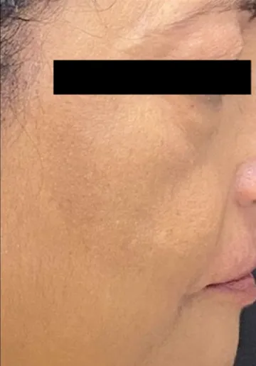 Dermal Fillers Before and after results at Dermatrix Clinic