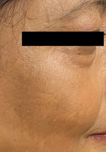 Dermal Fillers Before and after results at Dermatrix Clinic