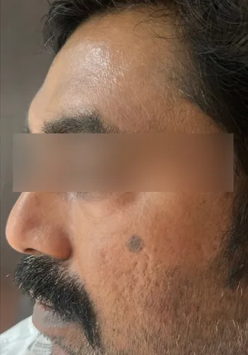 Cosmelan Peel Before and after results at Dermatrix Clinic