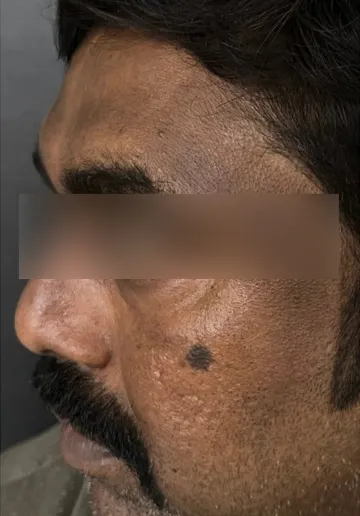 Cosmelan Peel Before and after results at Dermatrix Clinic