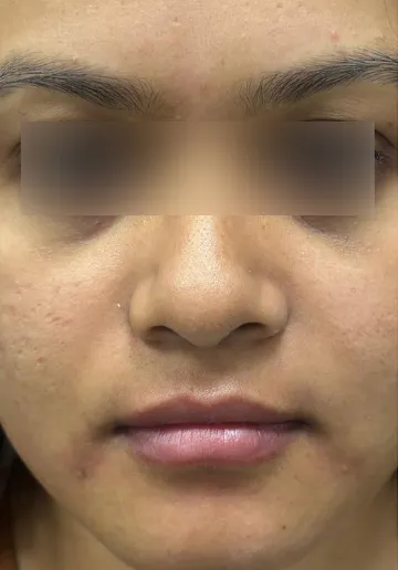Cosmelan Peel Before and after results at Dermatrix Clinic