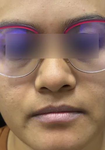 Cosmelan Peel Before and after results at Dermatrix Clinic