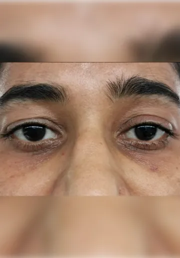 Dermal Fillers Before and after results at Dermatrix Clinic