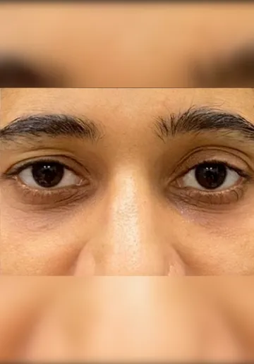 Dermal Fillers Before and after results at Dermatrix Clinic