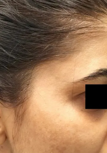 Dermal Fillers Before and after results at Dermatrix Clinic