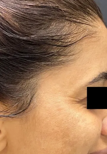 Dermal Fillers Before and after results at Dermatrix Clinic