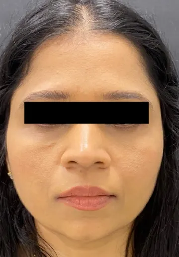 Dermal Fillers Before and after results at Dermatrix Clinic