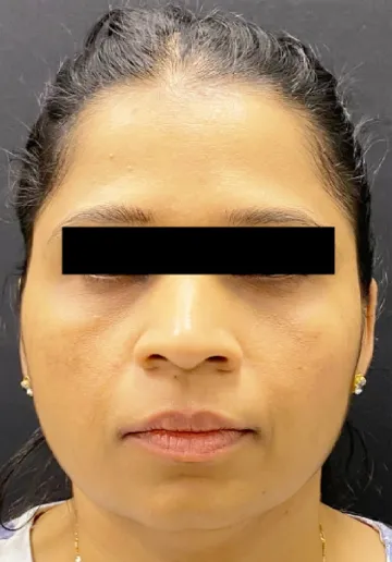 Dermal Fillers Before and after results at Dermatrix Clinic