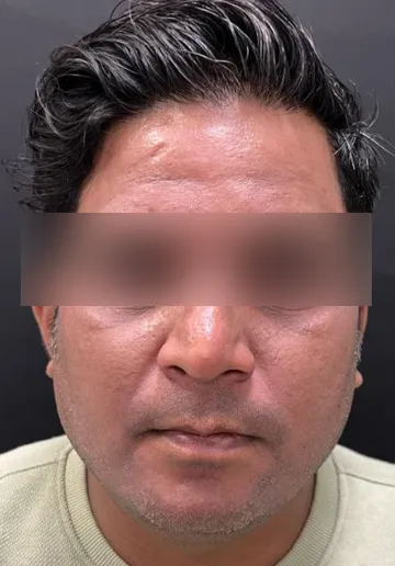 Cosmelan Peel Before and after results at Dermatrix Clinic