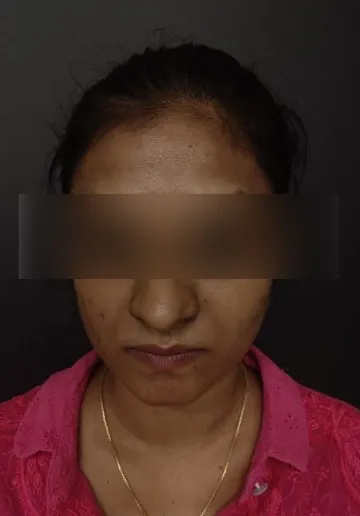 Cosmelan Peel Before and after results at Dermatrix Clinic
