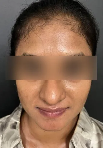 Cosmelan Peel Before and after results at Dermatrix Clinic