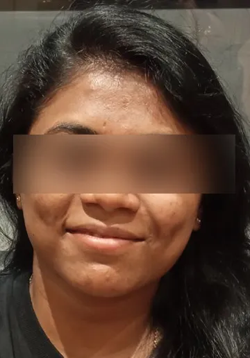 Cosmelan Peel Before and after results at Dermatrix Clinic