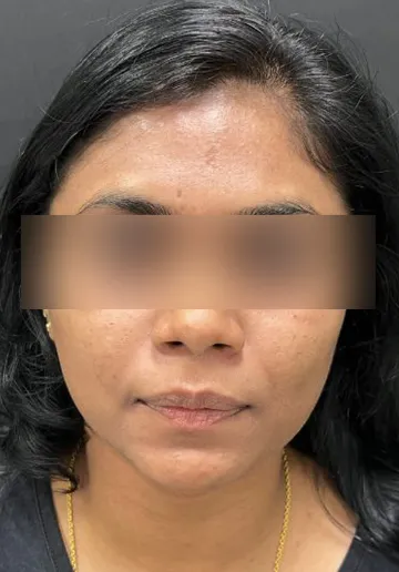 Cosmelan Peel Before and after results at Dermatrix Clinic