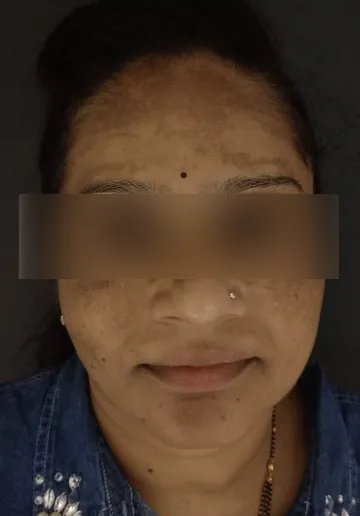 Cosmelan Peel Before and after results at Dermatrix Clinic