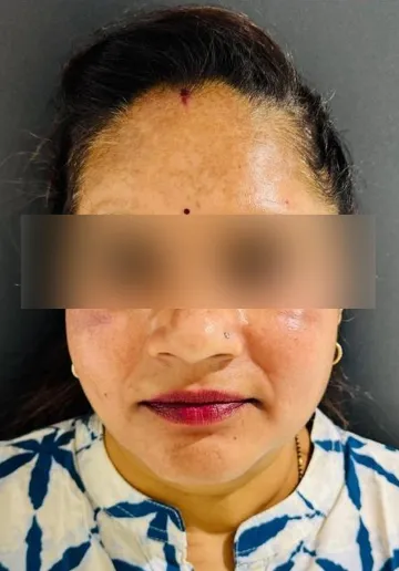 Cosmelan Peel Before and after results at Dermatrix Clinic