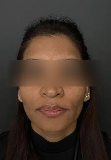 Cosmelan Peel Before and after results at Dermatrix Clinic