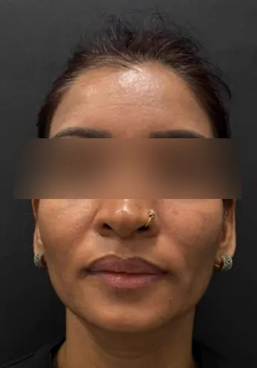 Cosmelan Peel Before and after results at Dermatrix Clinic