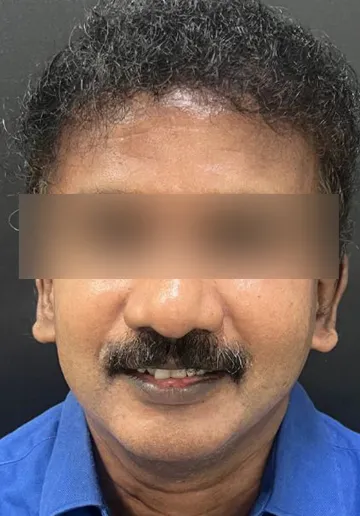 Cosmelan Peel Before and after results at Dermatrix Clinic