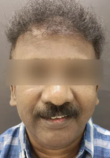 Cosmelan Peel Before and after results at Dermatrix Clinic