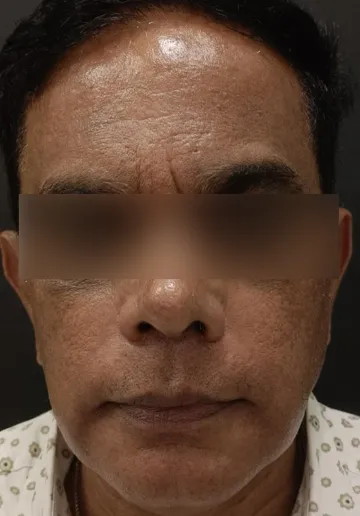 Cosmelan Peel Before and after results at Dermatrix Clinic