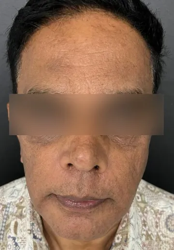 Cosmelan Peel Before and after results at Dermatrix Clinic