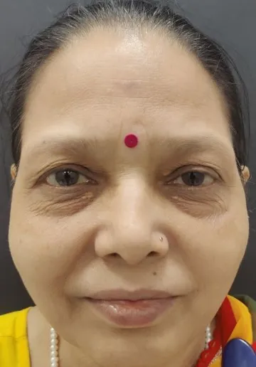 Xanthelasma Removal Before and after results at Dermatrix Clinic