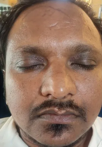Xanthelasma Removal Before and after results at Dermatrix Clinic
