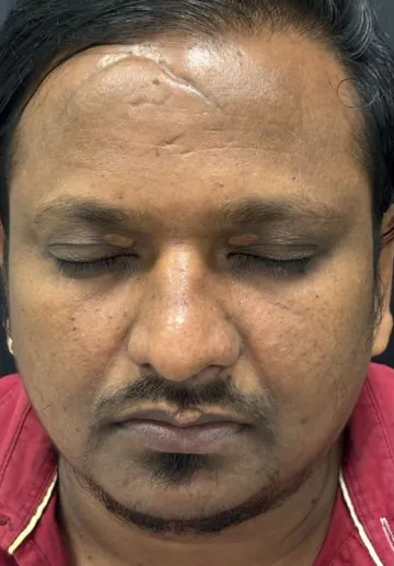 Xanthelasma Removal Before and after results at Dermatrix Clinic