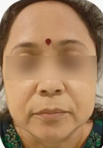 PRP Treatment for Face Before and after results at Dermatrix Clinic