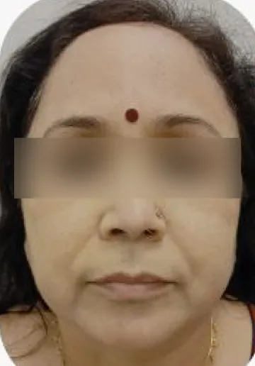 PRP Treatment for Face Before and after results at Dermatrix Clinic