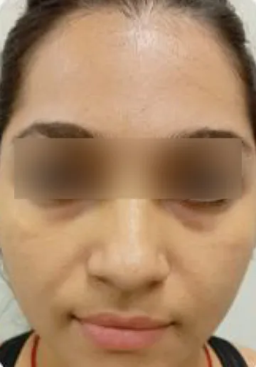 PRP Treatment for Face Before and after results at Dermatrix Clinic